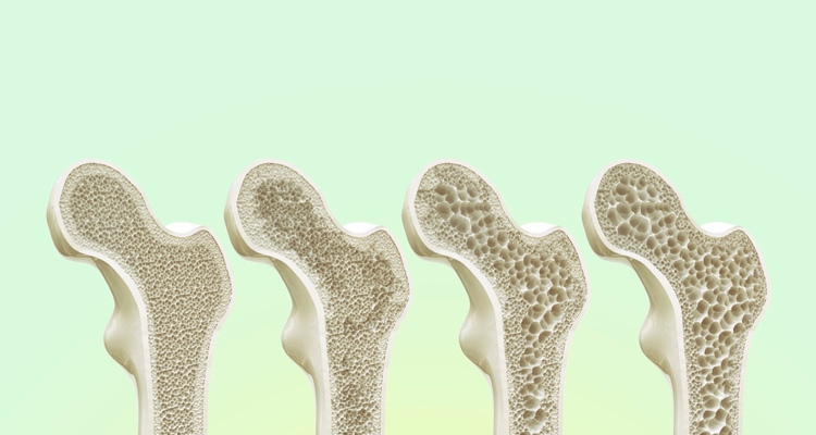 8 Faktor Risiko Osteoporosis 